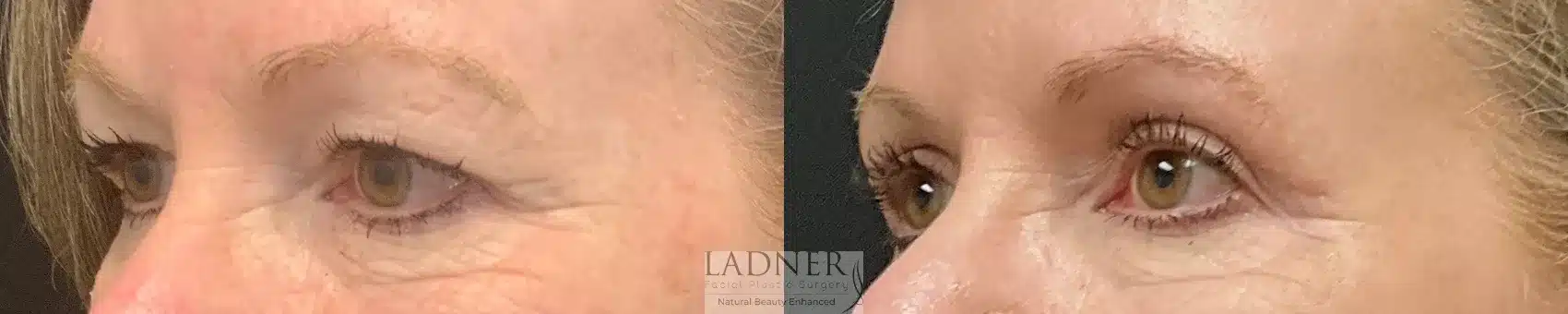 Before and After Image: Upper Blepharoplasty - left-front-oblique