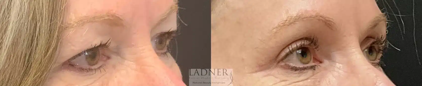 Before and After Image: Upper Blepharoplasty - right-front-oblique