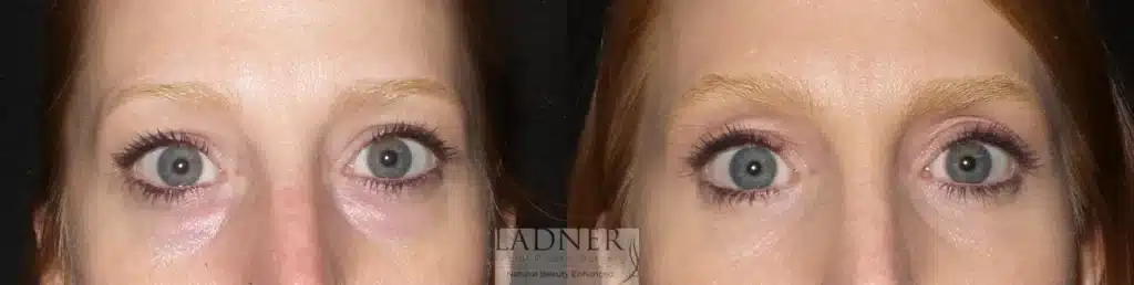 Before and After Image: Lower Blepharoplasty - front