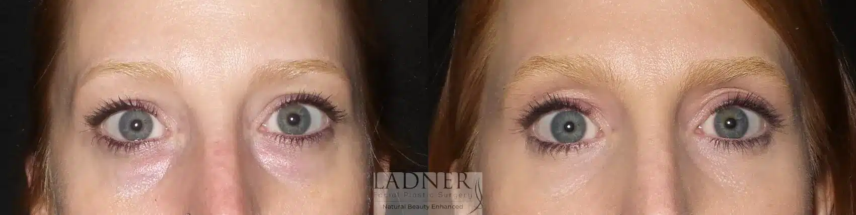 Before and After Image: Lower Blepharoplasty - front