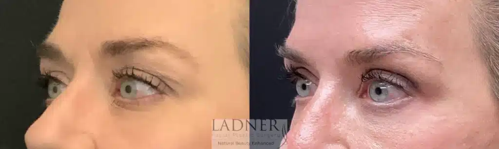 Before and After Image: Upper and Lower Blepharoplasty - front