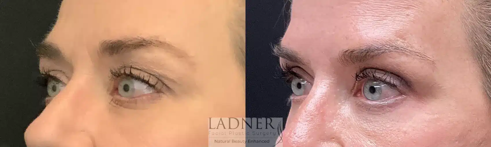 Before and After Image: Upper and Lower Blepharoplasty - front