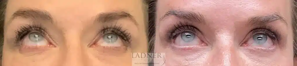 Before and After Image: Upper and Lower Blepharoplasty - front