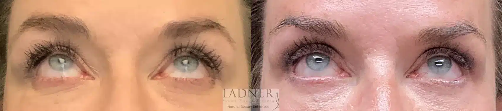 Before and After Image: Upper and Lower Blepharoplasty - front