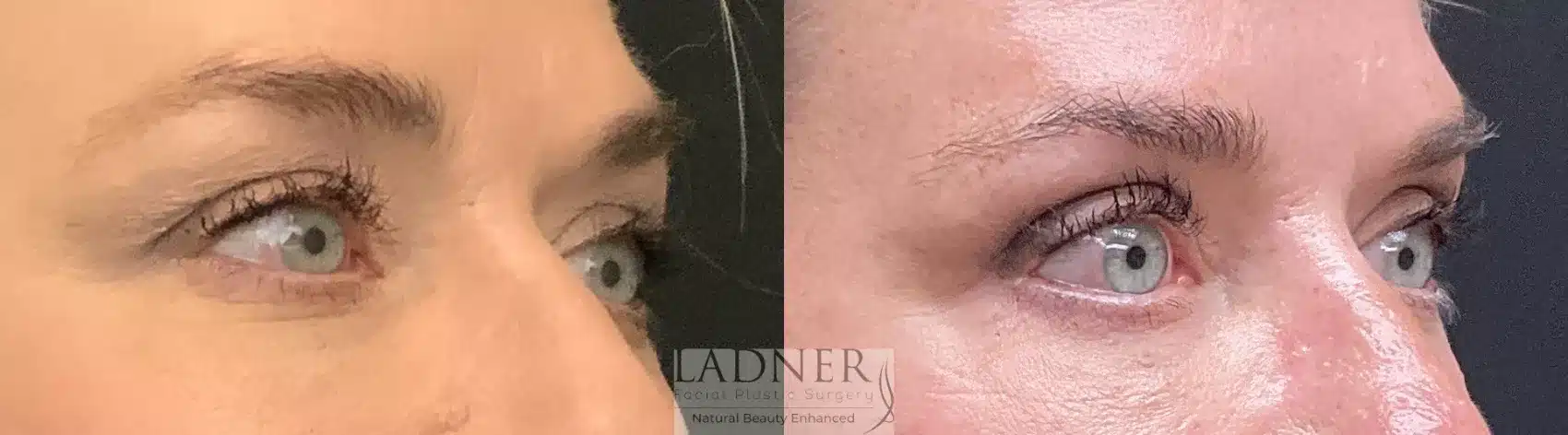 Before and After Image: Upper and Lower Blepharoplasty - right-front-oblique
