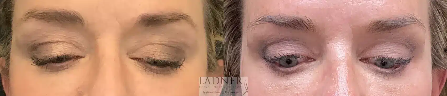 Before and After Image: Upper and Lower Blepharoplasty - front