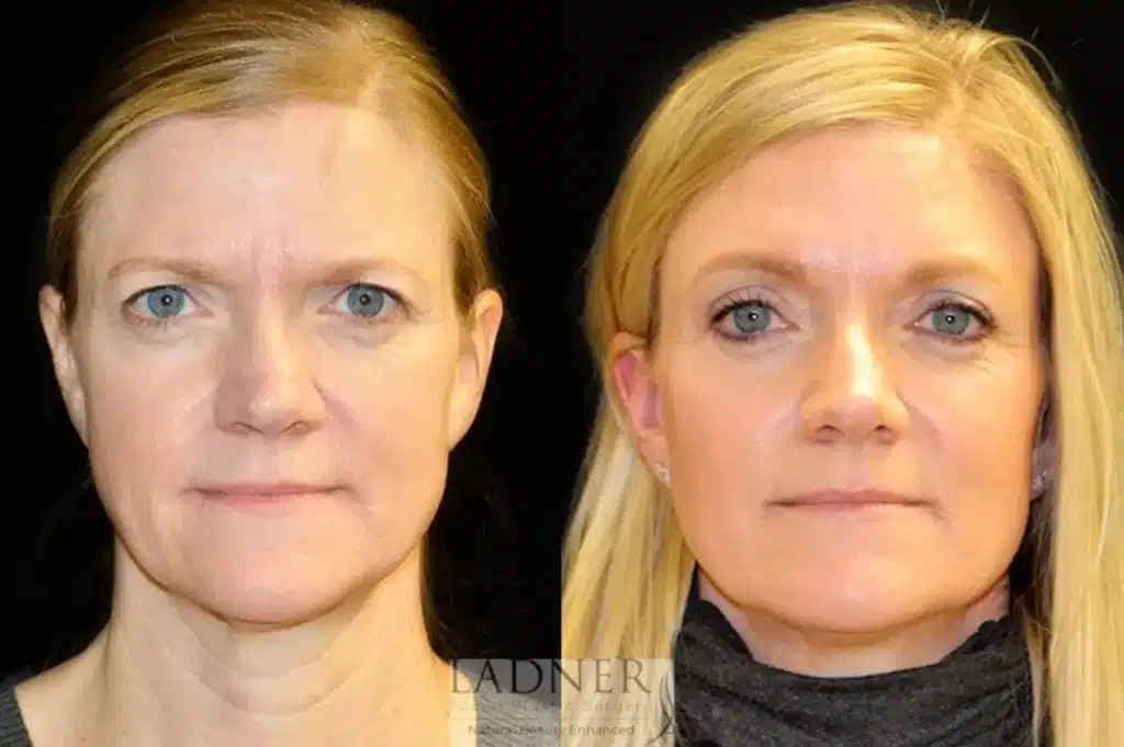 Before and After Image: Lower Blepharoplasty & Brow Lift/Forehead Lift - front