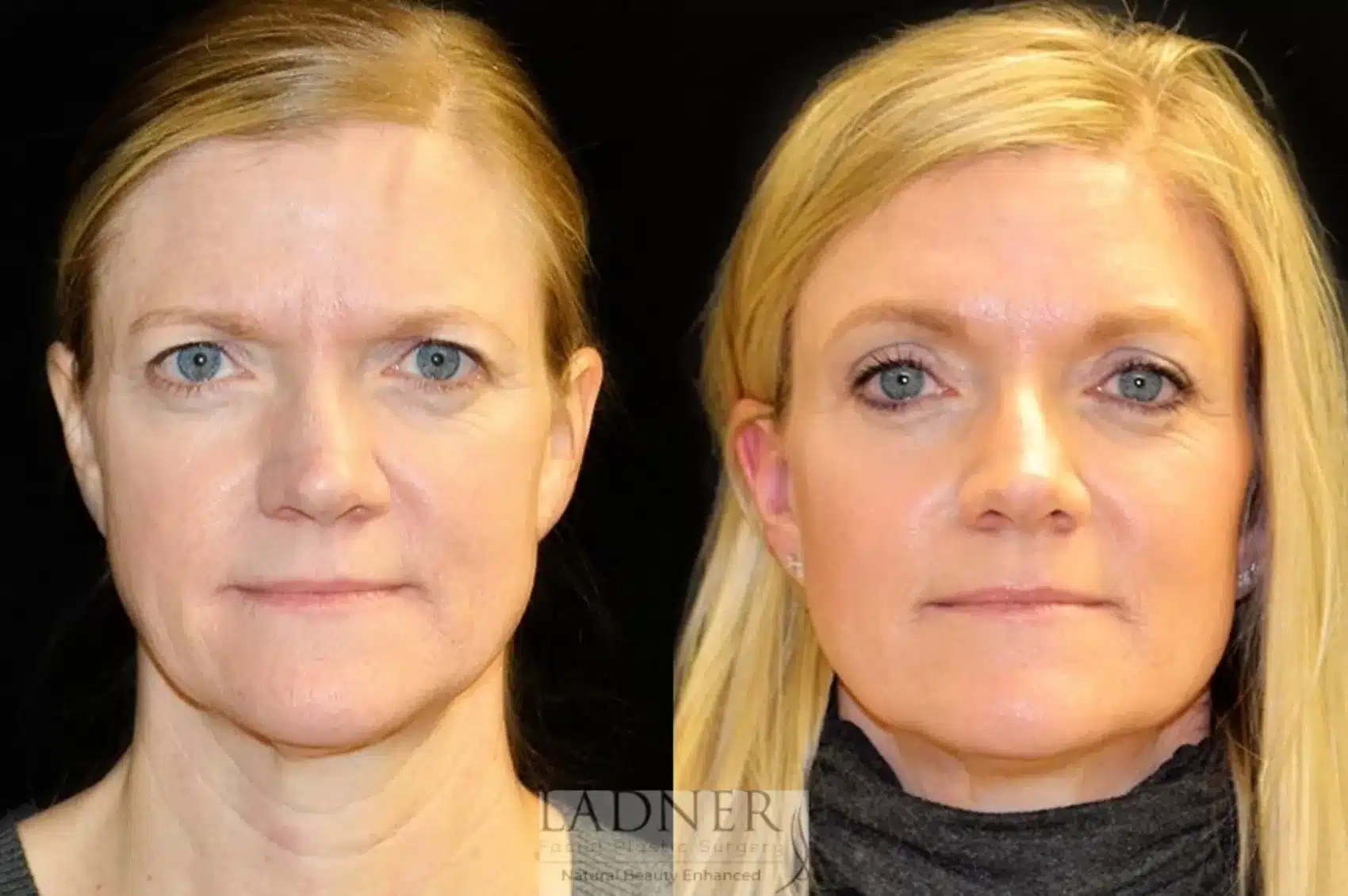 Before and After Image: Lower Blepharoplasty - front