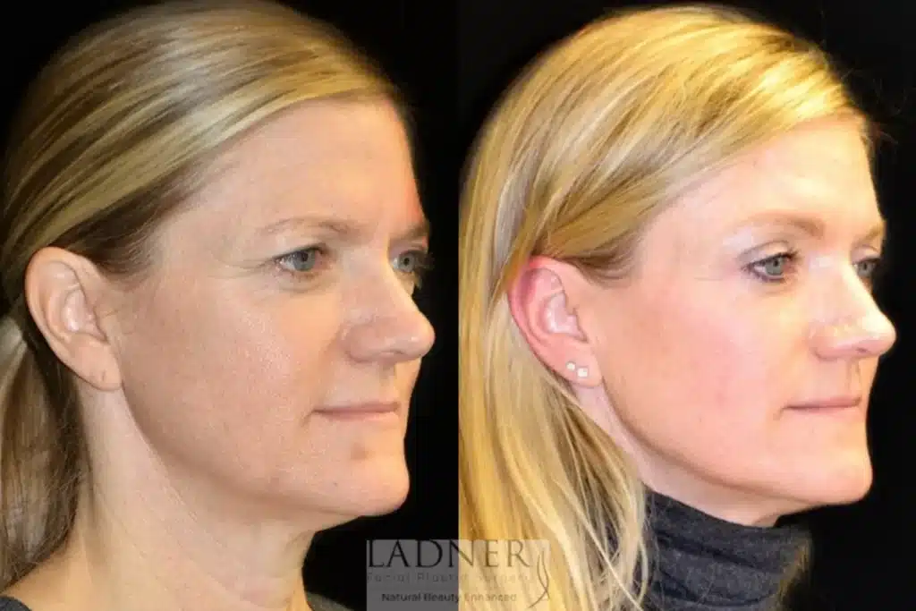 Before and After Image: Lower Blepharoplasty & Brow Lift/Forehead Lift - right-front-oblique