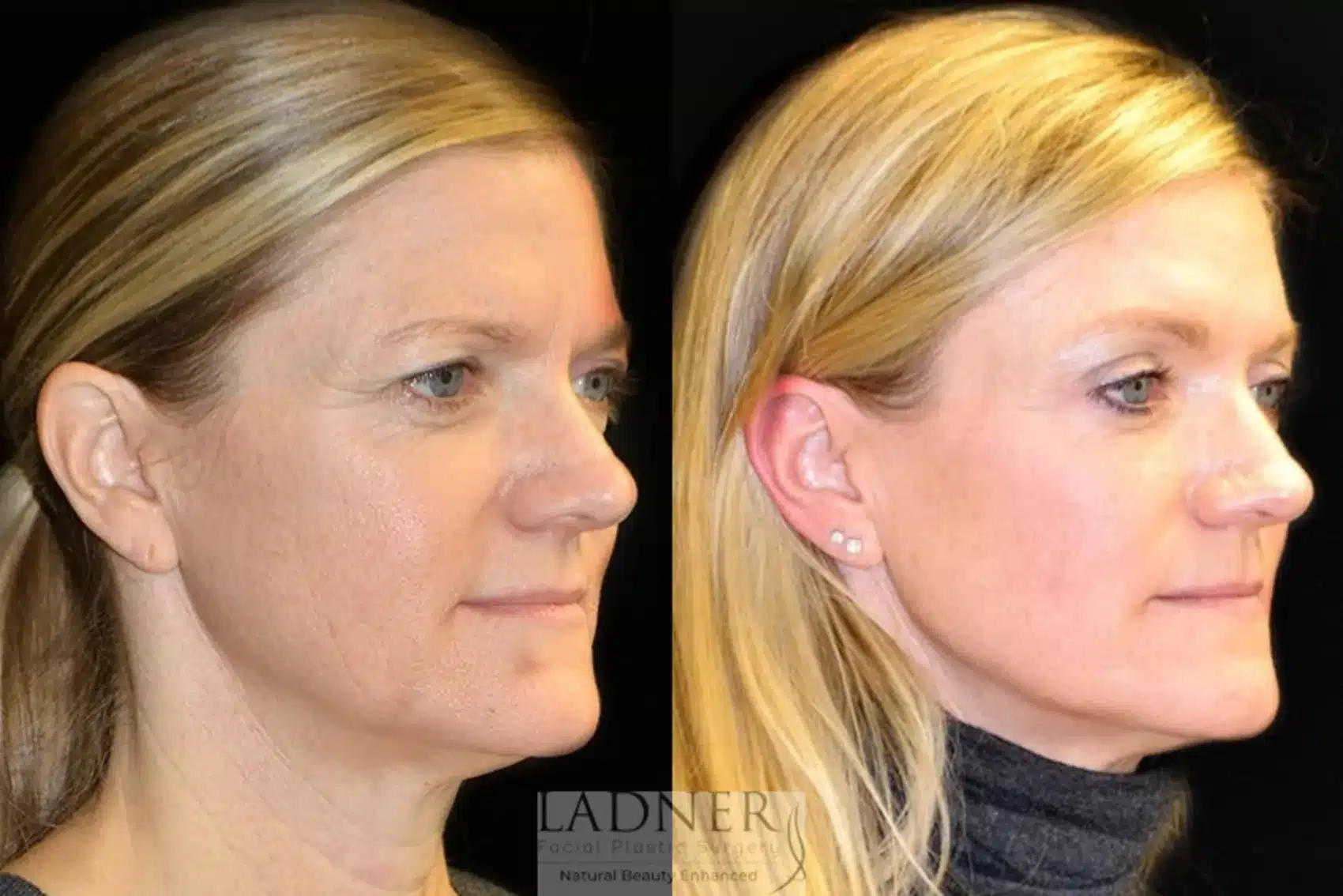 Before and After Image: Lower Blepharoplasty - right-front-oblique