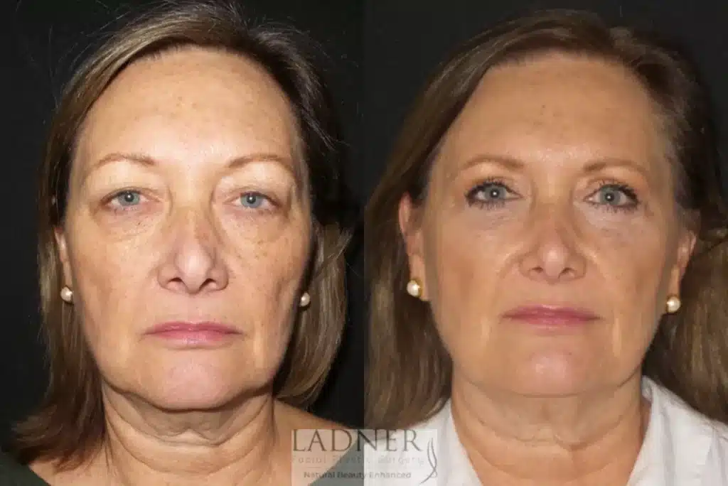 Before and After Image: Upper and Lower Blepharoplasty - front