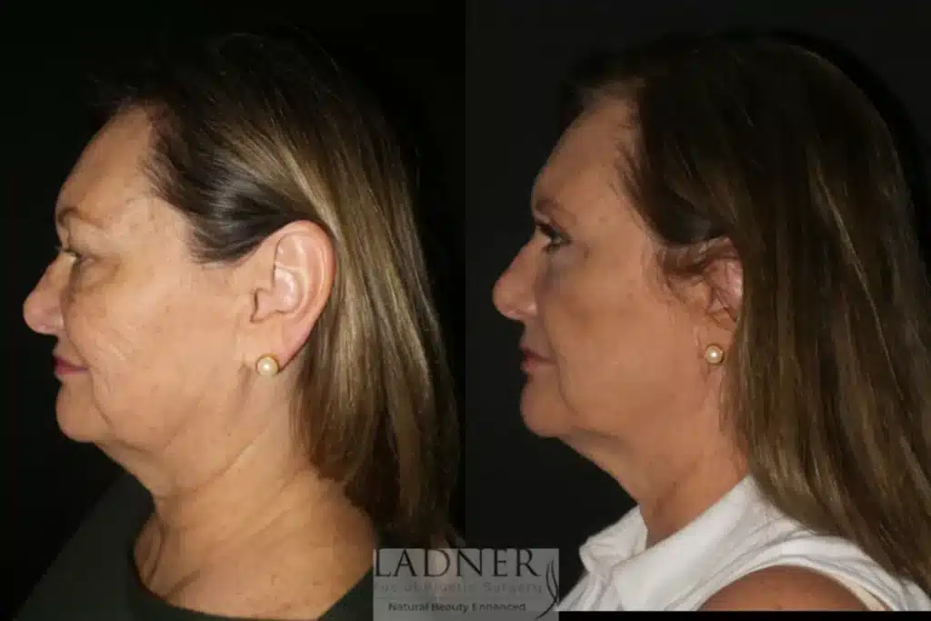 Before and After Image: Upper and Lower Blepharoplasty - left-side