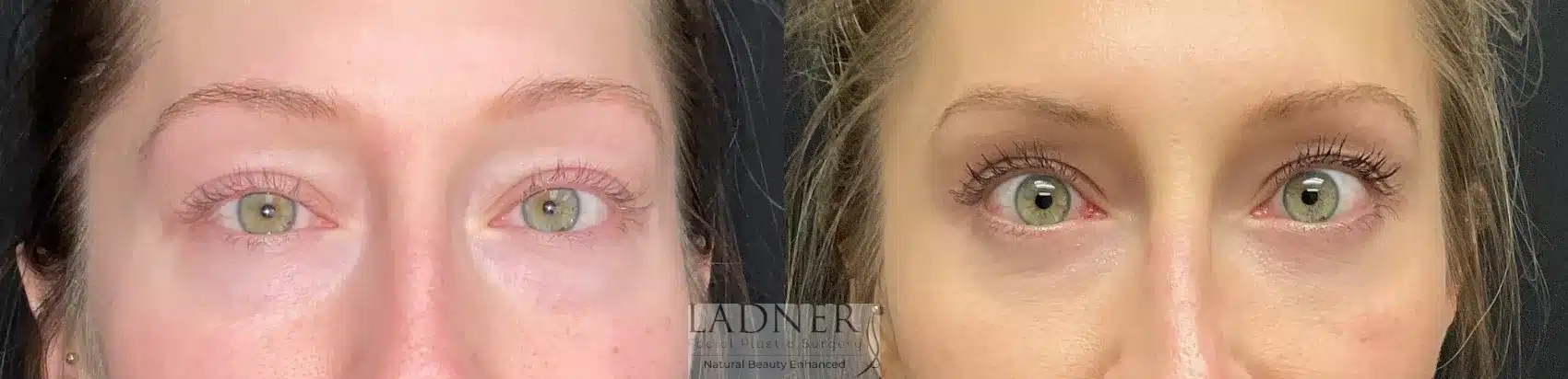 Before and After Image: Lower Blepharoplasty - front