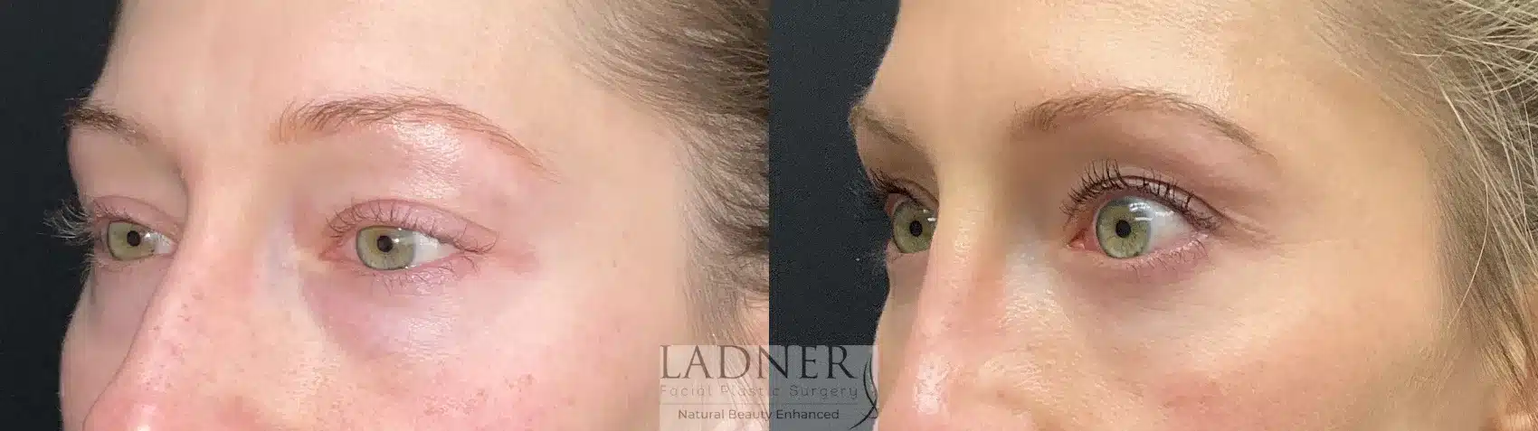 Before and After Image: Lower Blepharoplasty - left-front-oblique
