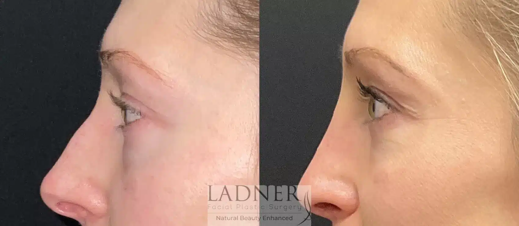 Before and After Image: Lower Blepharoplasty - left-side