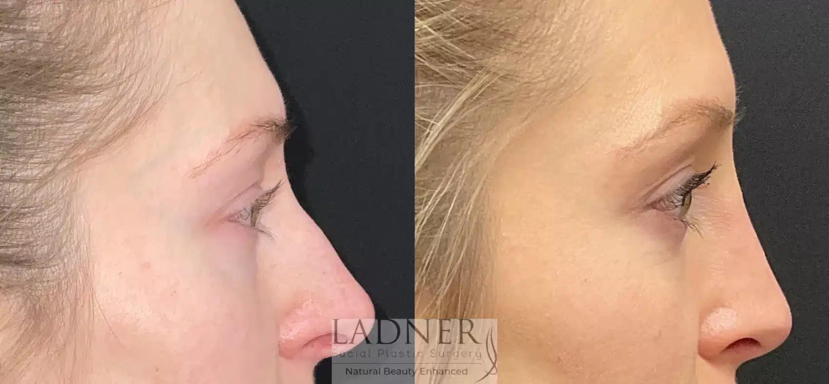 Before and After Image: Lower Blepharoplasty - right-side