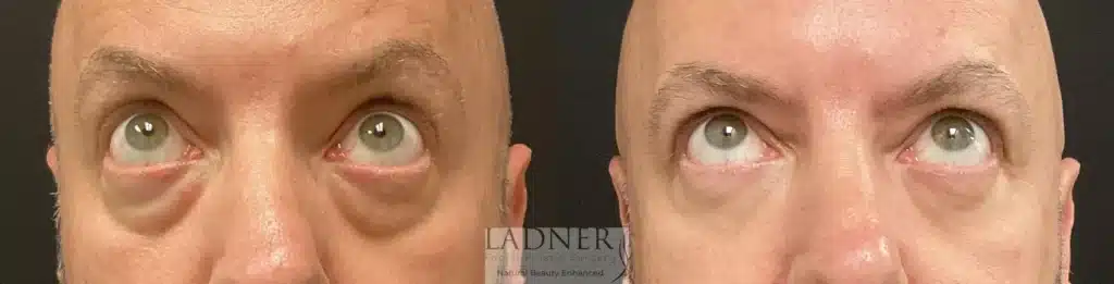 Before and After Image: Lower Blepharoplasty & Facial Plastic Surgery - front