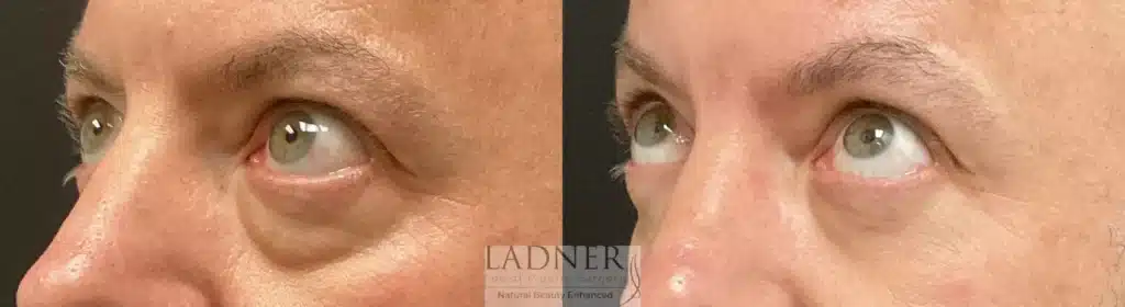 Before and After Image: Lower Blepharoplasty & Facial Plastic Surgery - left-front-oblique