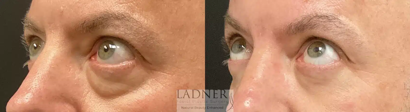 Before and After Image: Lower Blepharoplasty - left-front-oblique
