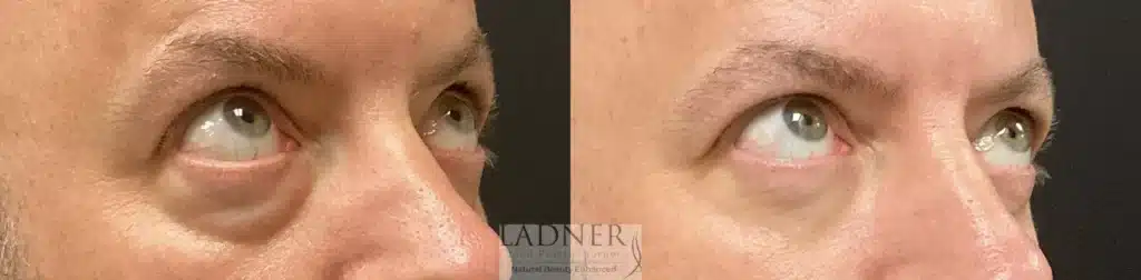 Before and After Image: Lower Blepharoplasty & Facial Plastic Surgery - right-front-oblique