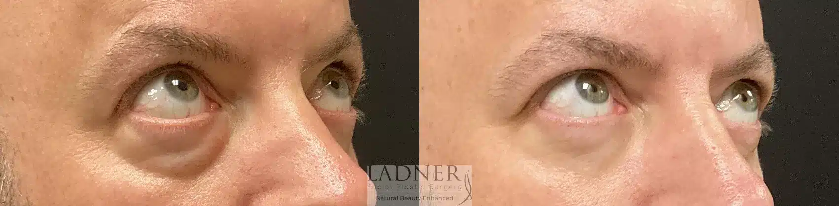 Before and After Image: Lower Blepharoplasty - right-front-oblique
