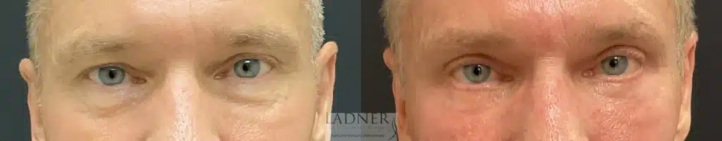 Before and After Image: Upper and Lower Blepharoplasty - front