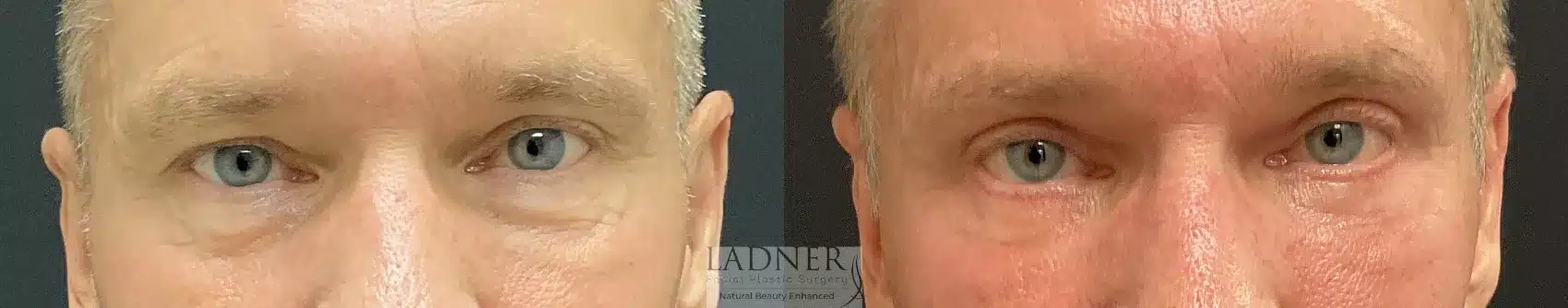 Before and After Image: Upper and Lower Blepharoplasty - front