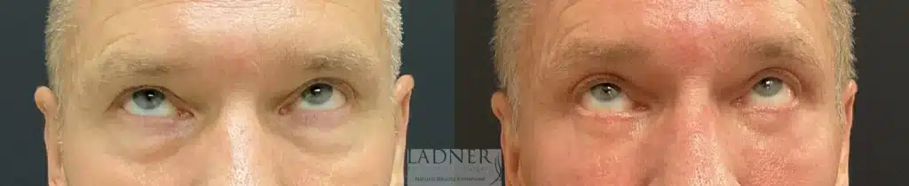 Before and After Image: Upper and Lower Blepharoplasty - front