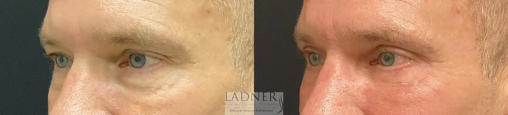 Before and After Image: Upper and Lower Blepharoplasty - left-front-oblique