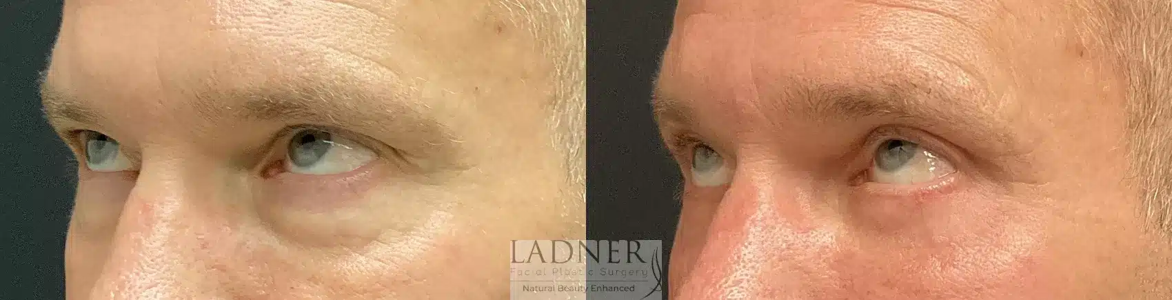 Before and After Image: Upper and Lower Blepharoplasty - left-front-oblique