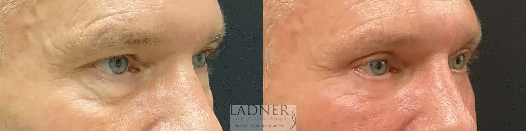 Before and After Image: Upper and Lower Blepharoplasty - right-front-oblique