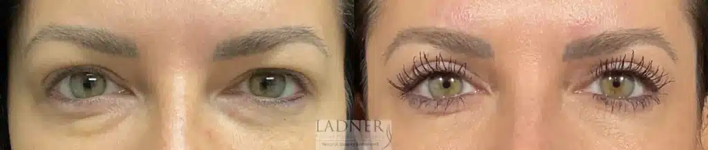 Before and After Image: Upper Blepharoplasty - front