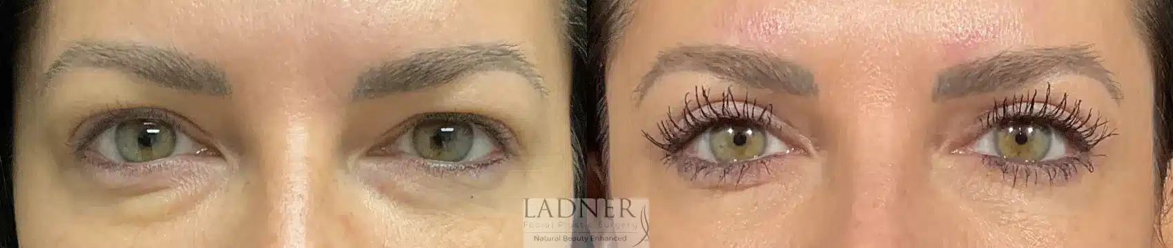 Before and After Image: Blepharoplasty - front