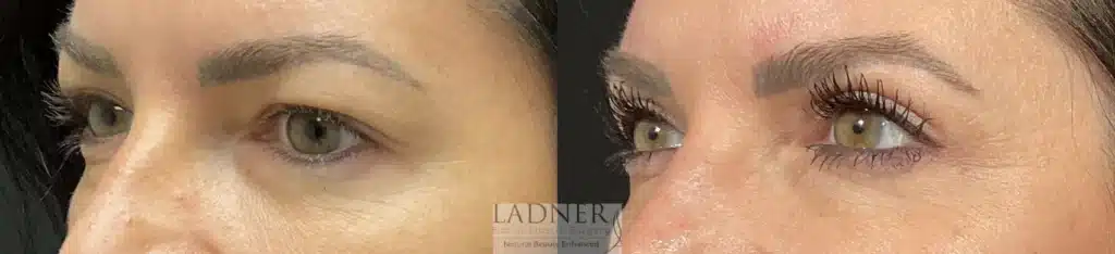 Before and After Image: Upper Blepharoplasty - left-front-oblique