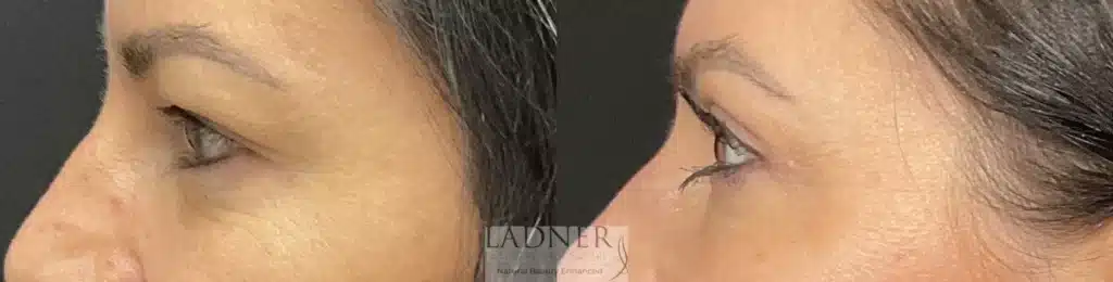 Before and After Image: Upper Blepharoplasty - left-side