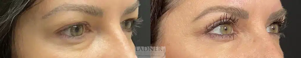 Before and After Image: Upper Blepharoplasty - right-front-oblique