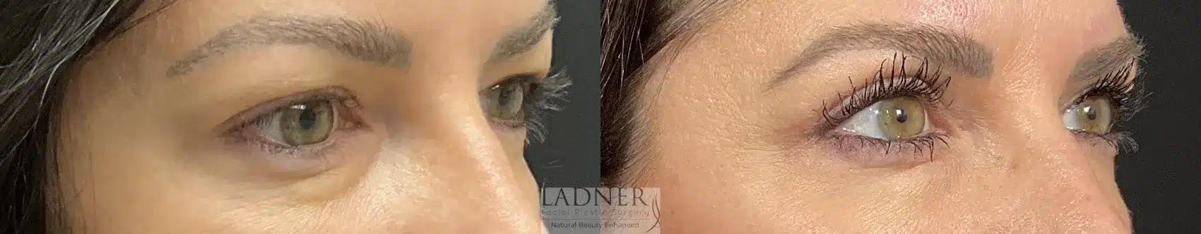 Before and After Image: Blepharoplasty - right-front-oblique