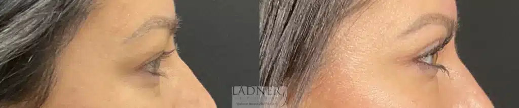Before and After Image: Upper Blepharoplasty - right-side