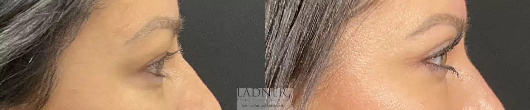 Before and After Image: Blepharoplasty - right-side