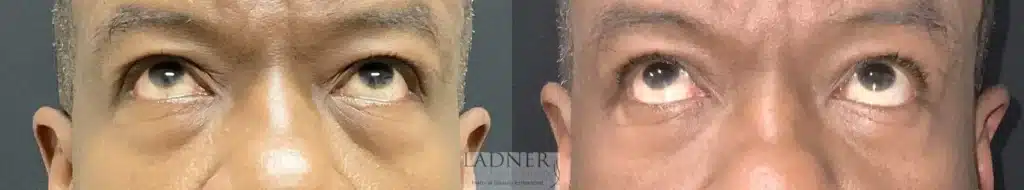 Before and After Image: Blepharoplasty & Facial Plastic Surgery - front