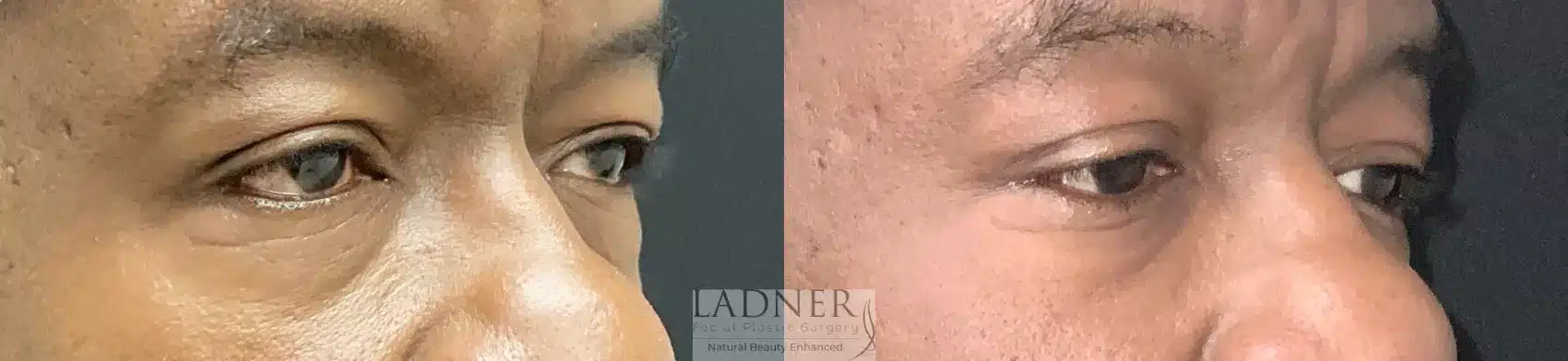 Before and After Image: Blepharoplasty - right-front-oblique