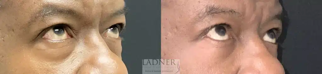 Before and After Image: Blepharoplasty & Facial Plastic Surgery - right-front-oblique
