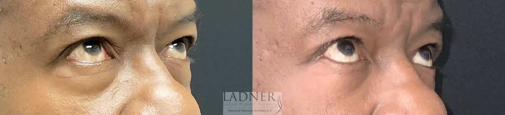 Before and After Image: Blepharoplasty - right-front-oblique
