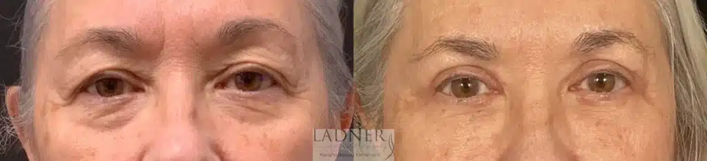 Before and After Image: Upper and Lower Blepharoplasty - front