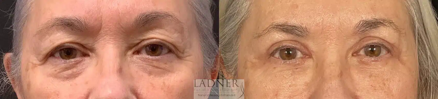 Before and After Image: Blepharoplasty - front