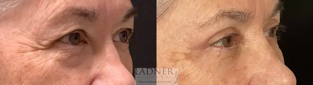 Before and After Image: Upper and Lower Blepharoplasty - right-front-oblique