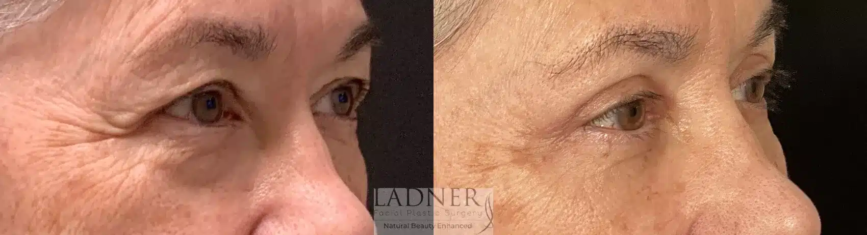 Before and After Image: Blepharoplasty - right-front-oblique