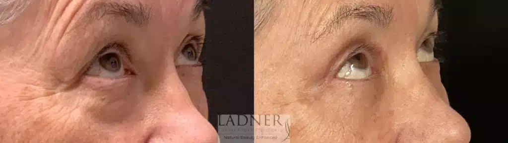 Before and After Image: Upper and Lower Blepharoplasty - right-front-oblique