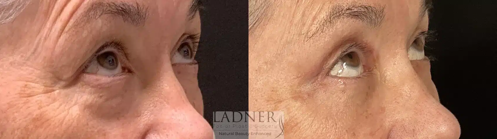 Before and After Image: Blepharoplasty - right-front-oblique