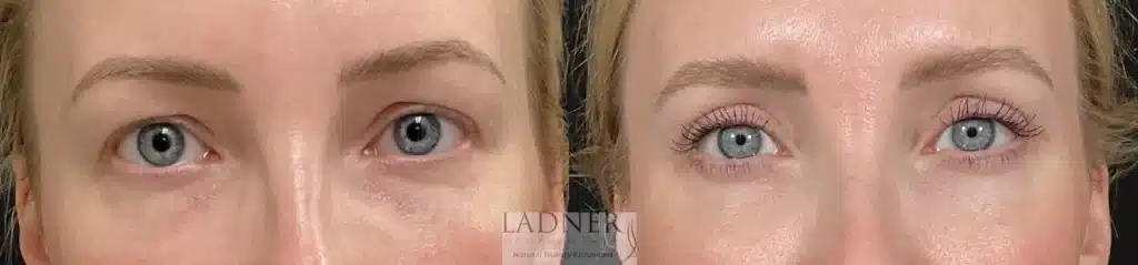 Before and After Image: Upper Blepharoplasty - front